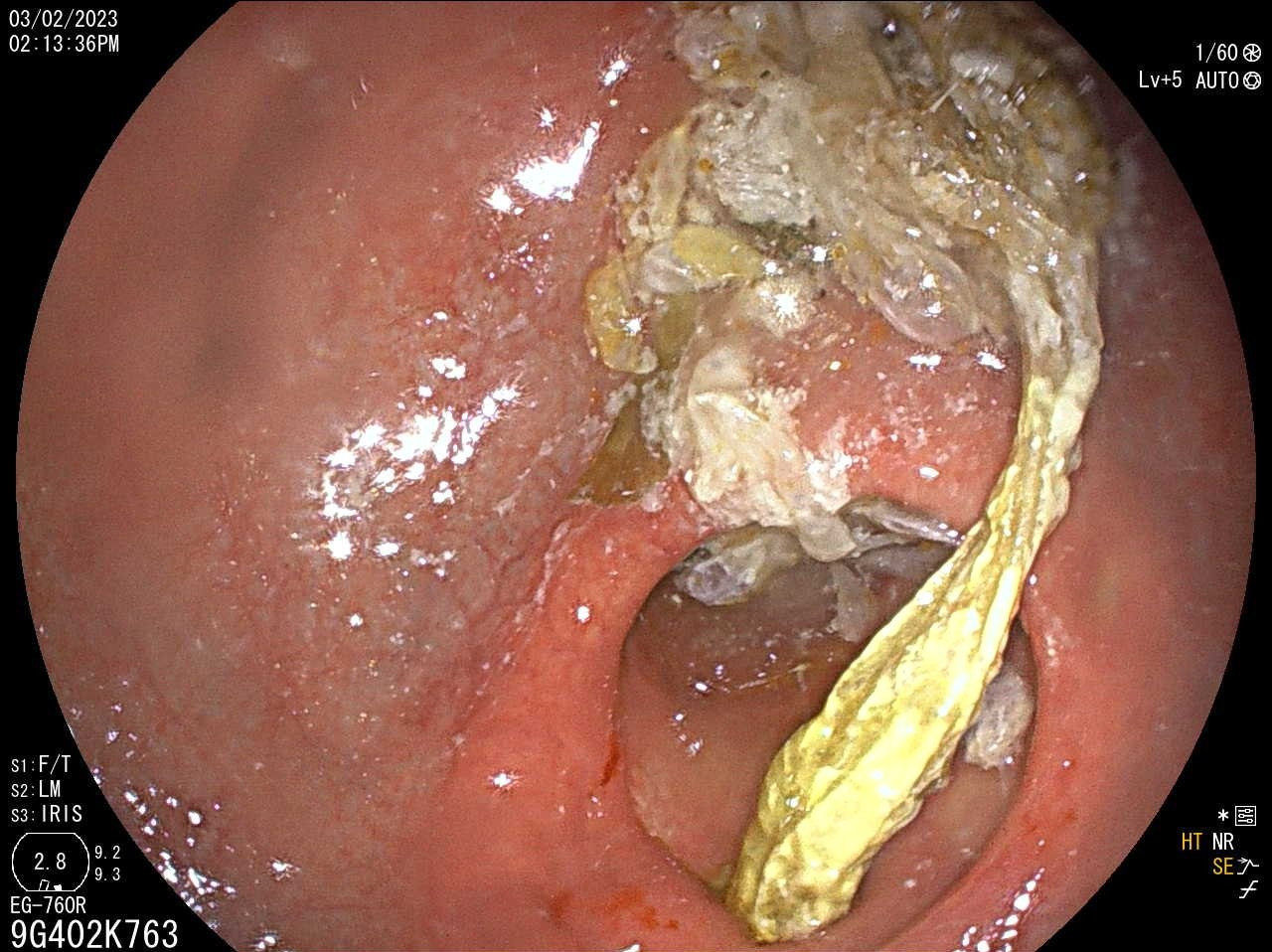 Dị vật là bã thức ăn có chiều dài gần 20cm. Ảnh: Bệnh viện cung cấp