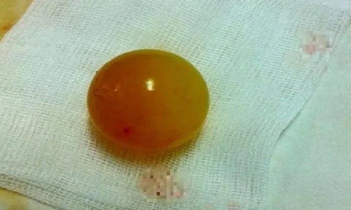 Dị vật là hạt nở được các bác sĩ lấy ra từ ruột của bé gái. (Ảnh: PLVN).