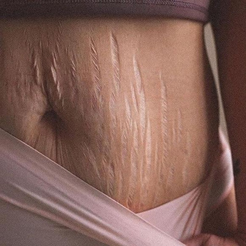 Mới đây, vợ của Phan Văn Đức đăng bức ảnh rạn da bụng sau khi sinh. Cô chia sẻ: 