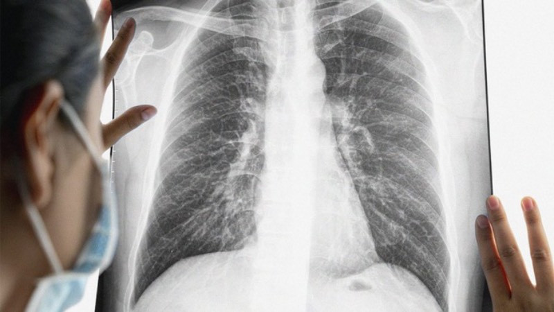 Bệnh nhân ung thư phổi ngày càng trẻ hóa. 