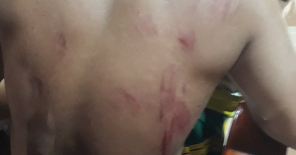 Anh Liêm bị tấn công thương tích khắp người