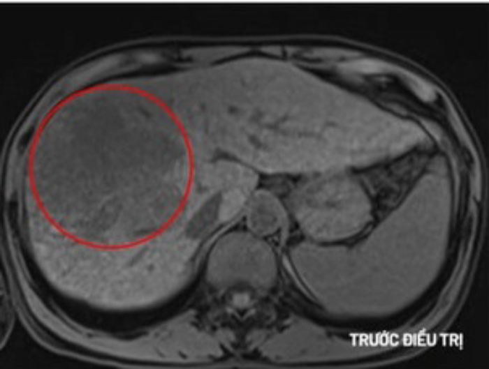 Hình ảnh khối u gan của nam bệnh nhân. Ảnh: BVCC.