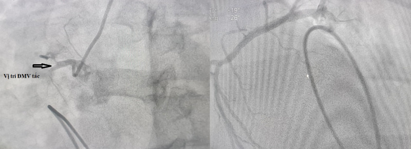 Hình ảnh chụp mạch vành của bệnh nhân trước và sau can thiệp. Ảnh: BVCC