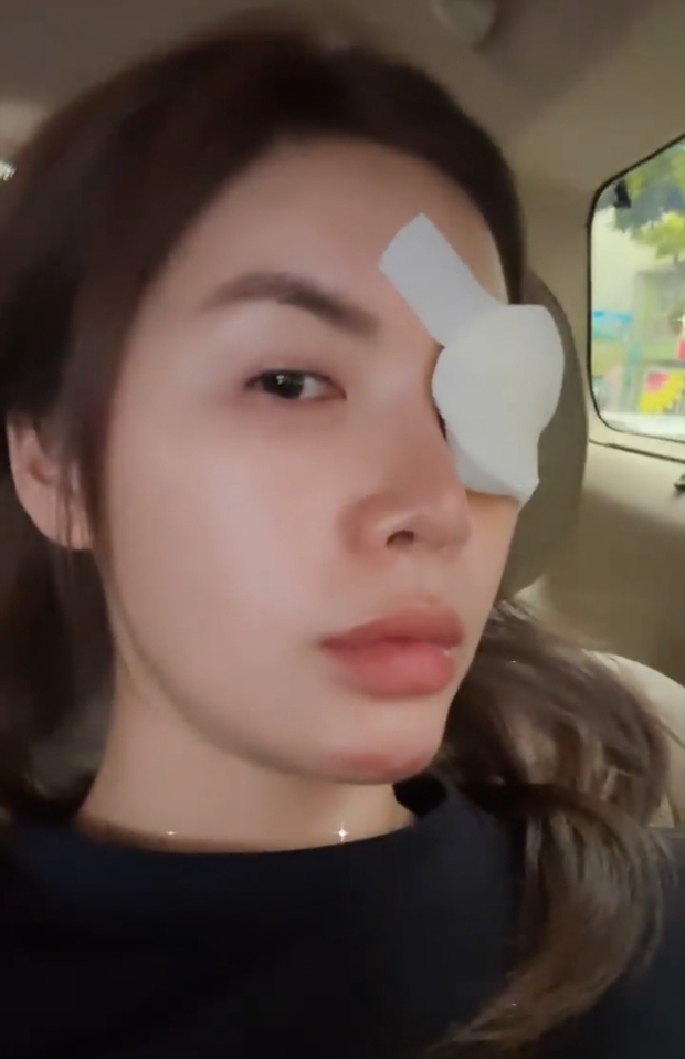 Minh Tú để lộ vết sẹo ở cằm và tiết lộ còn phải chữa lẹo mắt