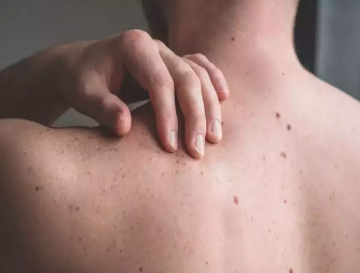 Nốt ruồi biến dạng trên bả vai cảnh báo ung thư da thể ác tính nhất Nốt ruồi biến dạng trên bả vai cảnh báo ung thư da thể ác tính nhất