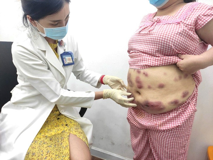 Một ca biến chứng sau tiêm tan mỡ được điều trị tại Bệnh viện Da liễu TP.HCM. Ảnh: BVCC.