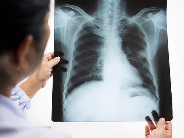 Chụp X-quang có thể phát hiện ung thư phổi (Ảnh: Shutterstock).