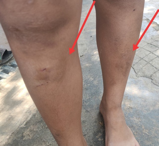 Một trong 5 cháu nhỏ bị mẹ con người phụ nữ đánh bầm dập