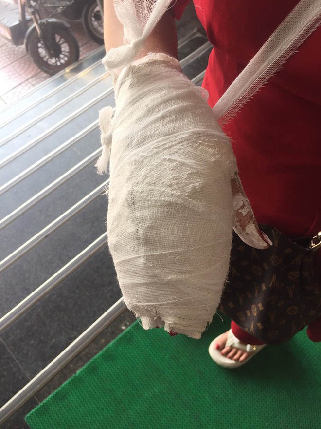 Chị V. bị gãy xương đốt ngón tay. Ảnh: NVCC