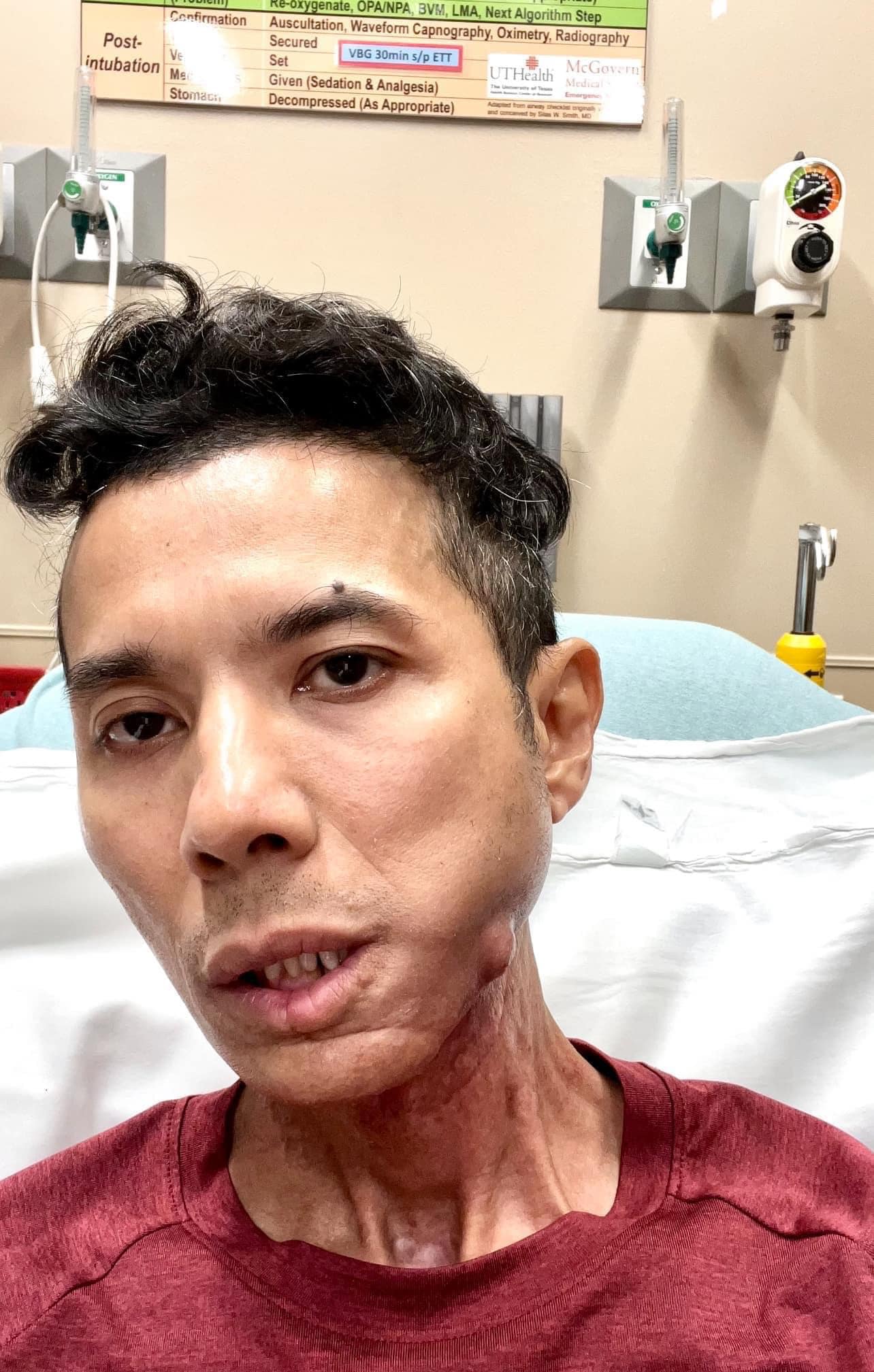 Hình ảnh Kasim trên giường bệnh, khuôn mặt gầy rộc với khối u ở cằm trái khiến nhiều người xót xa