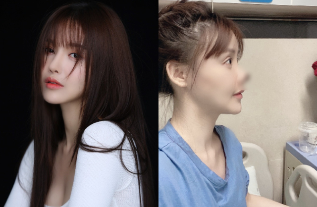 Chiếc mũi của Cao Lưu bị hỏng nặng, khiến diện mạo cô trông kém thẩm mỹ
