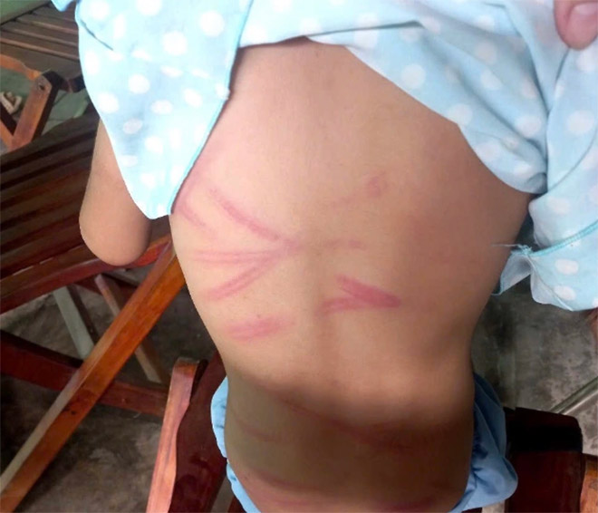 Những vết thương chằng chịt trên người cháu T. khiến ai nấy xót xa.