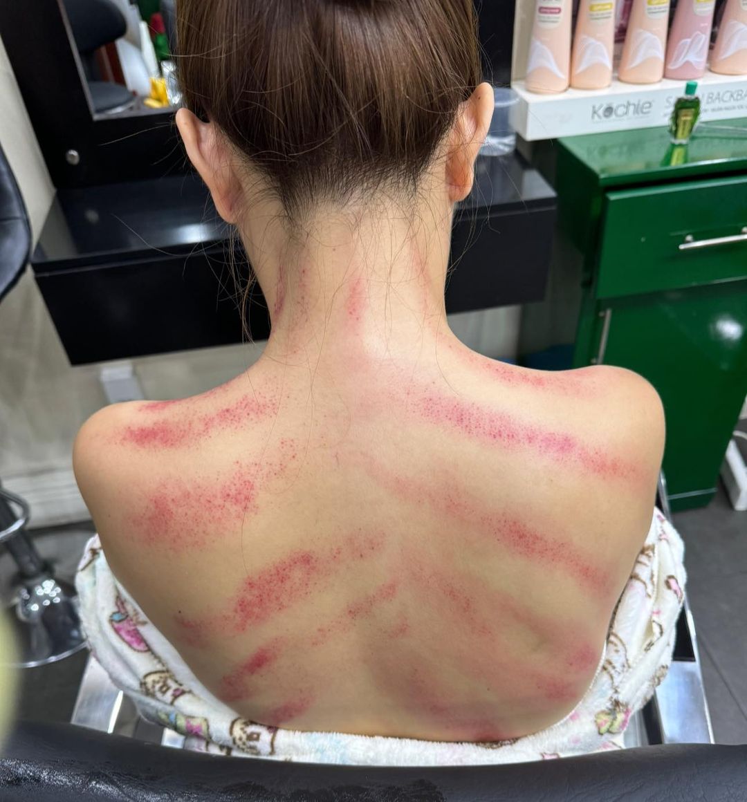 Hình ảnh bóng lưng chằng chịt những vết thâm tím được Phạm Quỳnh Anh đăng tải công khai trên trang cá nhân