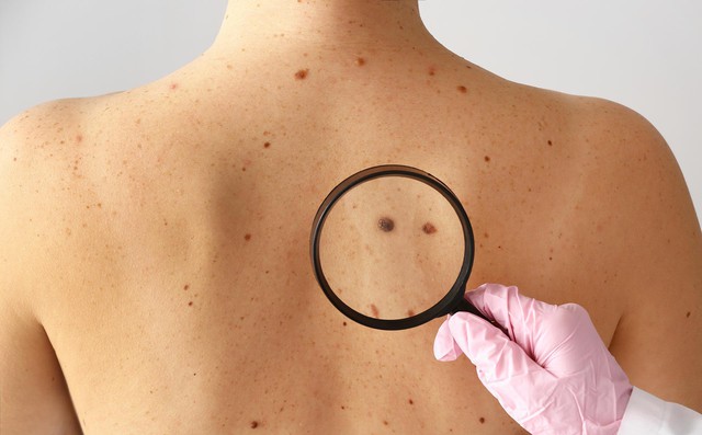 Nốt ruồi có thể là dấu hiệu cảnh báo ung thư da. (Ảnh: Duncan Dermatology)