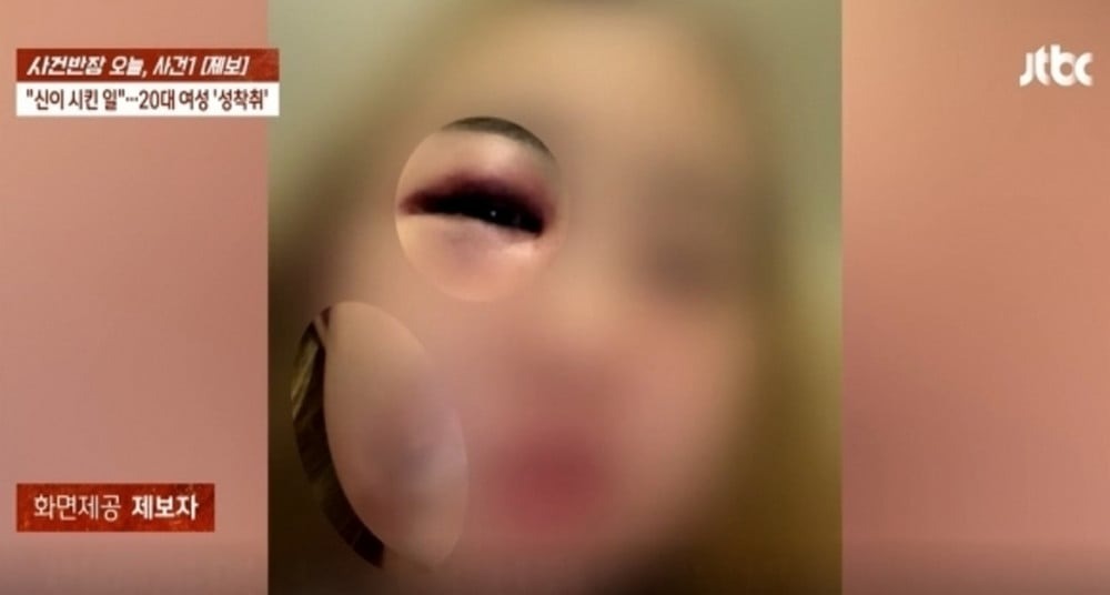 Hình ảnh gương mặt sưng húp, bầm tím của nạn nhân gây sốc cho dư luận Hàn Quốc