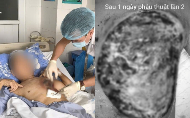 Vết thương phức tạp trên cơ thể bệnh nhân T.