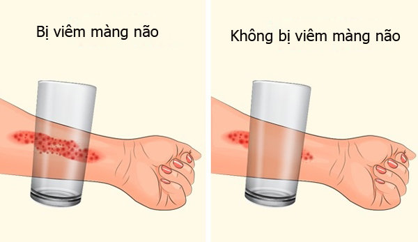 8 dấu hiệu viêm màng não ở trẻ đáng báo động, bố mẹ cần lưu ý - 7 8 dấu hiệu viêm màng não ở trẻ đáng báo động, bố mẹ cần lưu ý - 7