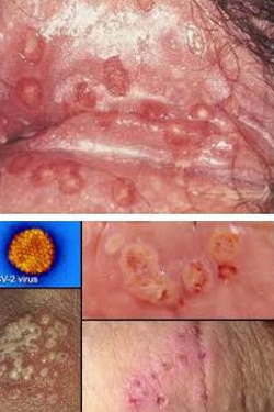 Mụn cóc sinh dục: Dễ lây, khó chữa Mụn cóc sinh dục: Dễ lây, khó chữa