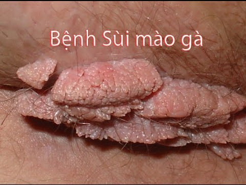Thuốc uống trong và dùng ngoài trị bệnh sùi mào gà - 1 Thuốc uống trong và dùng ngoài trị bệnh sùi mào gà - 1