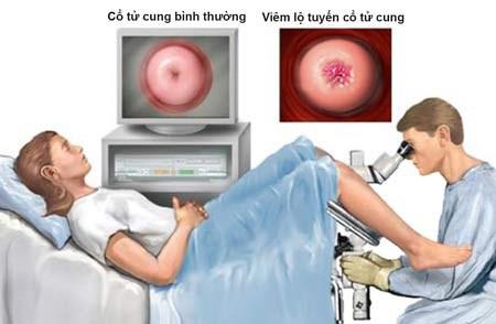 Đốt viêm lộ tuyến cổ tử cung ở phòng khám ngoài, cô gái 9X 'ngớ người' nhận hậu quả - 1 Đốt viêm lộ tuyến cổ tử cung ở phòng khám ngoài, cô gái 9X 'ngớ người' nhận hậu quả - 1