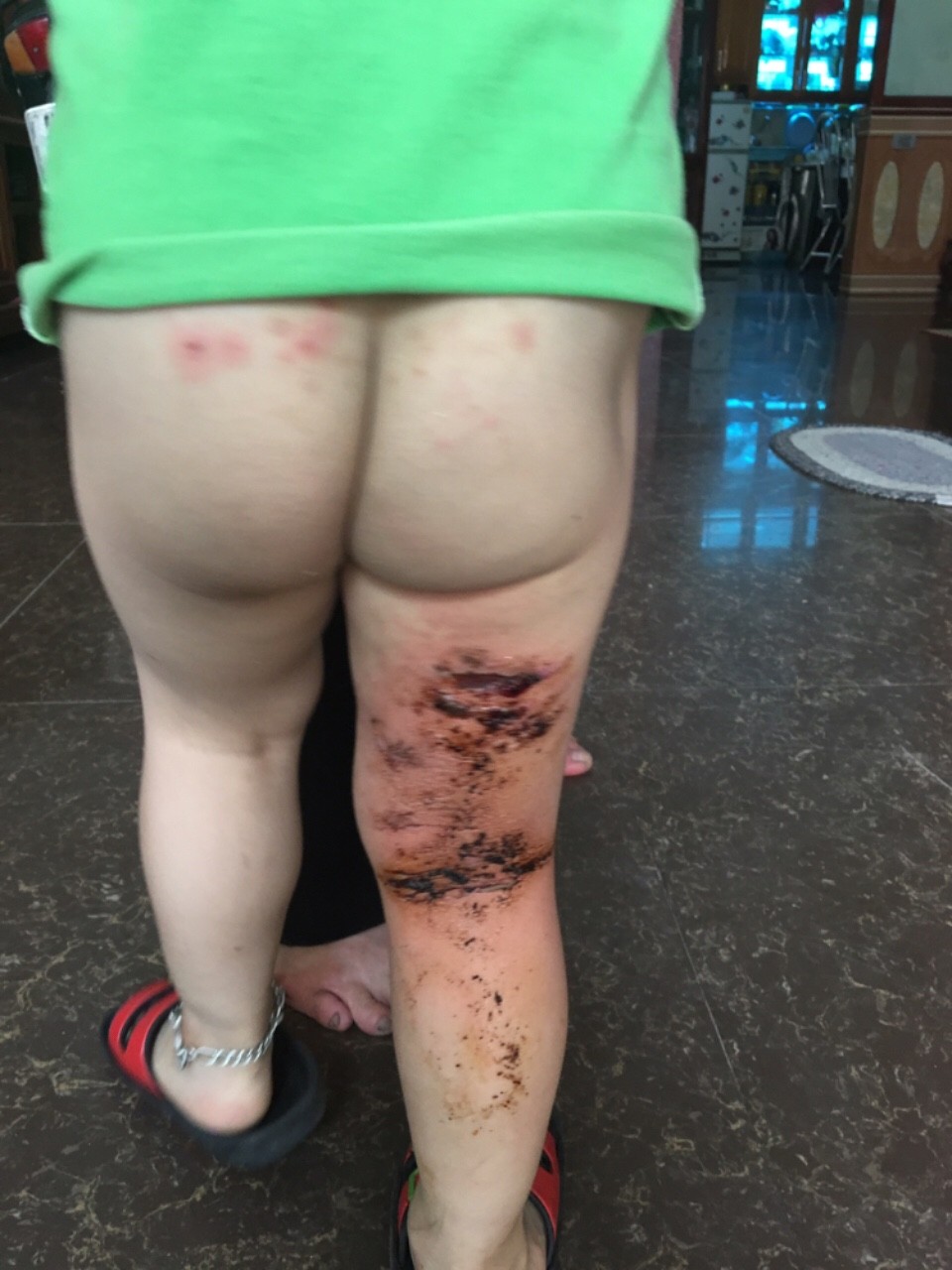 Xôn xao vụ việc trẻ mầm non bị bỏng do cô giáo dùng vòi nước nóng xịt rửa