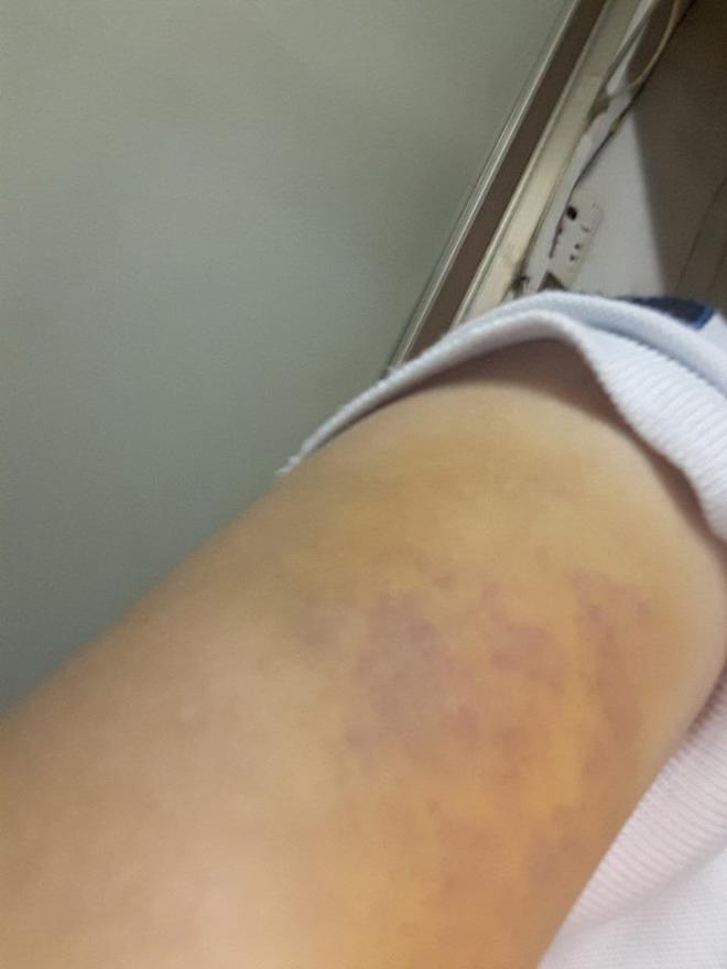 TP.HCM: Vợ bị bồ nhí của chồng đánh ghen ngược, dùng tuýp sắt đánh đập dã man