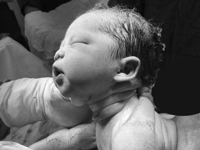 Bé Sài Gòn chào đời với dây rốn quấn chặt cổ: Các mẹ hốt hoảng, bác sĩ bảo 'chuyện thường' Bé Sài Gòn chào đời với dây rốn quấn chặt cổ: Các mẹ hốt hoảng, bác sĩ bảo 'chuyện thường'