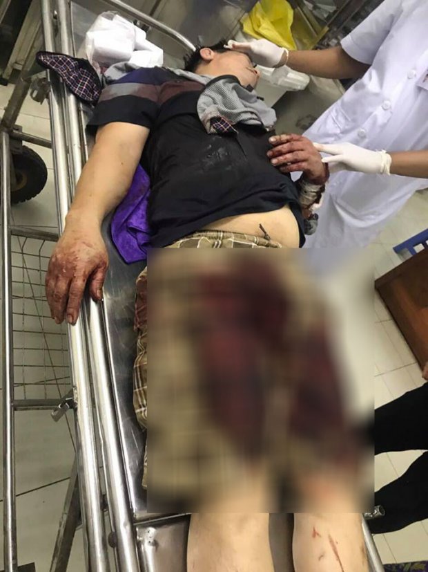 Nhóm côn đồ truy sát khiến 2 cha con phải nhập viện cấp cứu