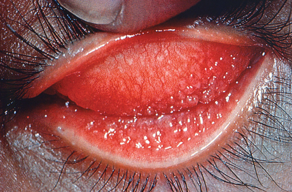 Nhiễm chlamydia trachomatis sinh dục - tiết niệu và những hệ lụy - 1 Nhiễm chlamydia trachomatis sinh dục - tiết niệu và những hệ lụy - 1