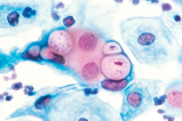 Nhiễm chlamydia trachomatis sinh dục - tiết niệu và những hệ lụy Nhiễm chlamydia trachomatis sinh dục - tiết niệu và những hệ lụy
