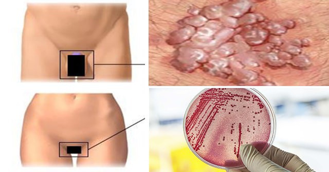 Bác sĩ người Anh cảnh báo xuất hiện thêm siêu vi khuẩn kháng kháng sinh lây qua đường tình dục - 1 Bác sĩ người Anh cảnh báo xuất hiện thêm siêu vi khuẩn kháng kháng sinh lây qua đường tình dục - 1