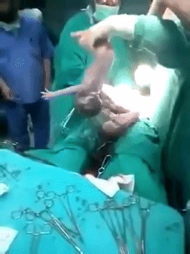Hiếm thấy: Clip sinh mổ khiến các bác sĩ trong nghề lẫn người xem 'nín thở' vì đếm mãi không hết số thai nhi - 3 Hiếm thấy: Clip sinh mổ khiến các bác sĩ trong nghề lẫn người xem 'nín thở' vì đếm mãi không hết số thai nhi - 3