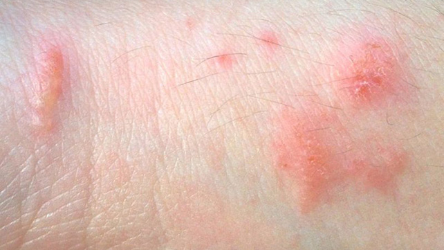 Phát ban sinh dục: Có chữa khỏi được không? Phát ban sinh dục: Có chữa khỏi được không?