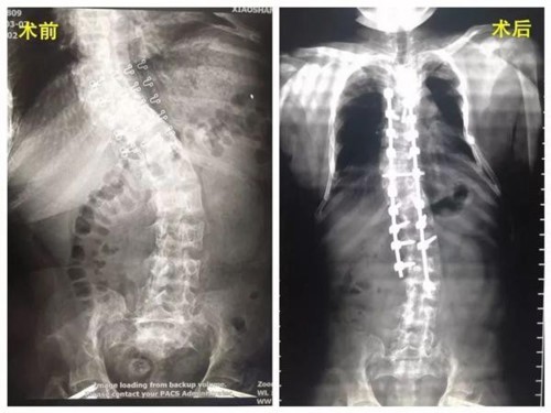 Sáng dậy cô gái 17 tuổi bỗng thấy lùn đi 5cm, nhìn phim chụp liền hiểu lý do - 1 Sáng dậy cô gái 17 tuổi bỗng thấy lùn đi 5cm, nhìn phim chụp liền hiểu lý do - 1