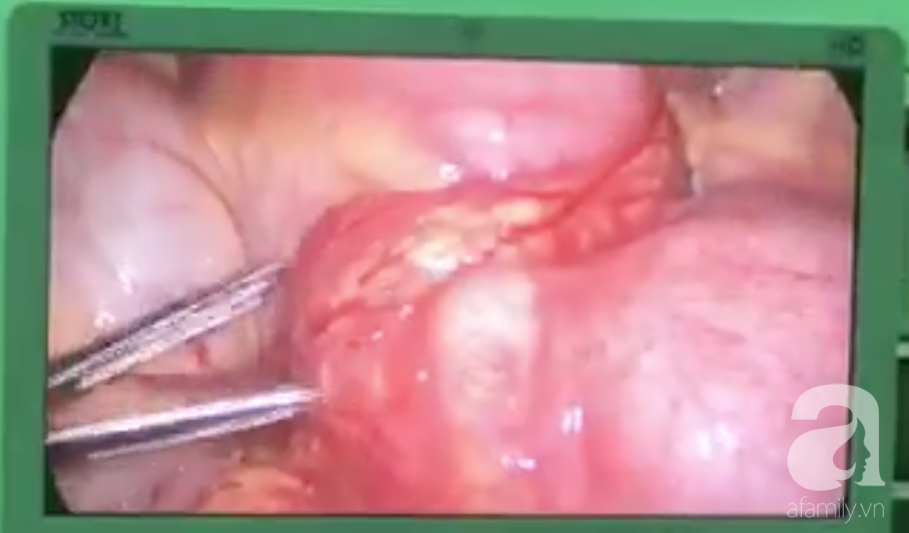 Chàng trai suýt mất mạng bởi thói quen tai hại 7 ngày trước và đáng tiếc đó cũng là thói quen của rất nhiều người Việt Chàng trai suýt mất mạng bởi thói quen tai hại 7 ngày trước và đáng tiếc đó cũng là thói quen của rất nhiều người Việt
