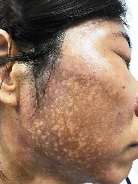 Hãi hùng mặt lở loét, mọc đầy lông vì dùng kem trộn chữa trứng cá, nám má - 3 Hãi hùng mặt lở loét, mọc đầy lông vì dùng kem trộn chữa trứng cá, nám má - 3
