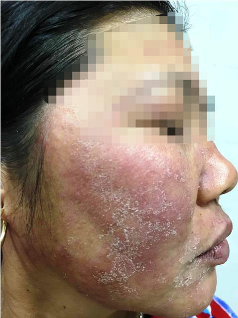 Hãi hùng mặt lở loét, mọc đầy lông vì dùng kem trộn chữa trứng cá, nám má - 4 Hãi hùng mặt lở loét, mọc đầy lông vì dùng kem trộn chữa trứng cá, nám má - 4
