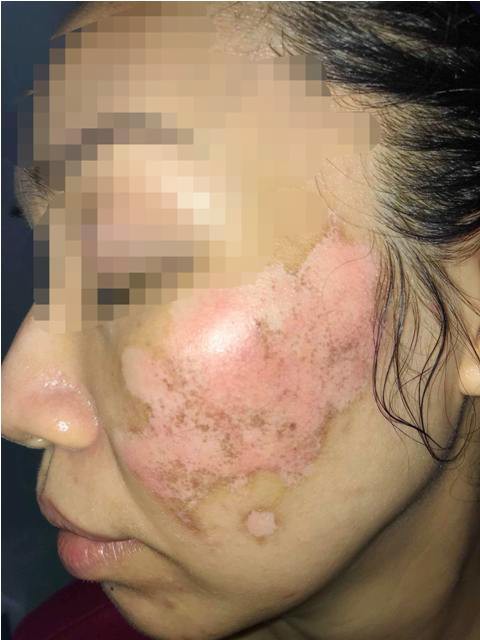 Hãi hùng mặt lở loét, mọc đầy lông vì dùng kem trộn chữa trứng cá, nám má - 5 Hãi hùng mặt lở loét, mọc đầy lông vì dùng kem trộn chữa trứng cá, nám má - 5