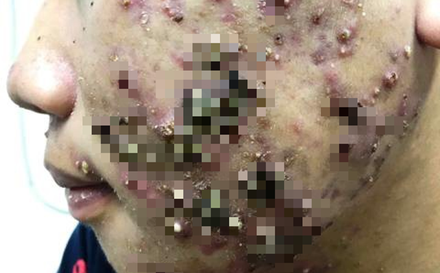 Hãi hùng mặt lở loét, mọc đầy lông vì dùng kem trộn chữa trứng cá, nám má Hãi hùng mặt lở loét, mọc đầy lông vì dùng kem trộn chữa trứng cá, nám má