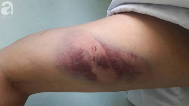 Hải Phòng: Người đàn ông kiệt quệ sau khi bị 'bạn gái' thuê 5 côn đồ truy sát Hải Phòng: Người đàn ông kiệt quệ sau khi bị 'bạn gái' thuê 5 côn đồ truy sát