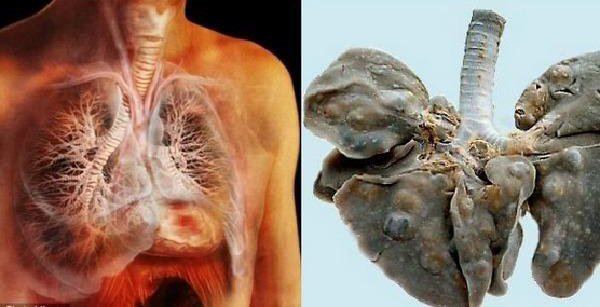 Sán lúc nhúc trong phổi thanh niên 19 tuổi vì món ăn nhiều người Việt thích - 1 Sán lúc nhúc trong phổi thanh niên 19 tuổi vì món ăn nhiều người Việt thích - 1