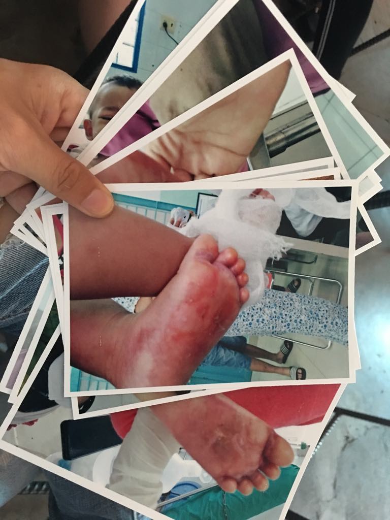 Gia đình bức xúc vì bé gái 2 tuổi nghi bị nhúng chân vào nước sôi tại trường mầm non ở Sài Gòn