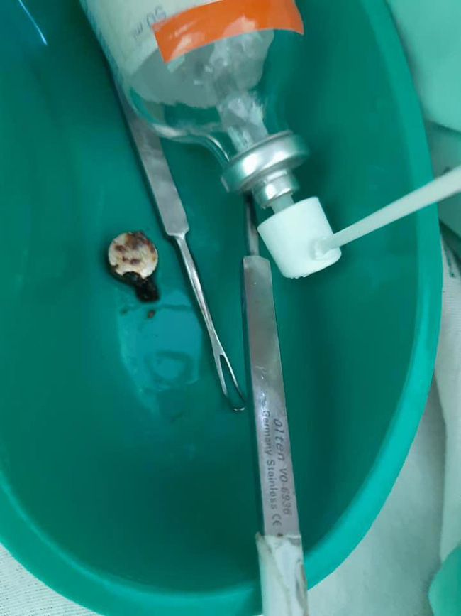 Con gái kêu đau đầu, mẹ nghi con bị dị ứng, tự tiện mua thuốc giảm đau nhưng rồi ngã quỵ khi bác sĩ lấy ra thứ kinh dị này - 4 Con gái kêu đau đầu, mẹ nghi con bị dị ứng, tự tiện mua thuốc giảm đau nhưng rồi ngã quỵ khi bác sĩ lấy ra thứ kinh dị này - 4