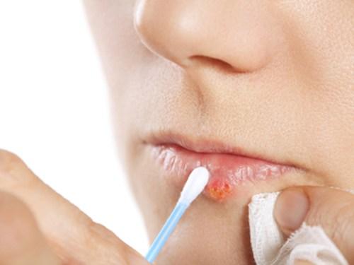 Oral sex: Con đường ngắn nhất dẫn đến nhiều căn bệnh nguy hiểm nếu bỏ qua những lưu ý sau Oral sex: Con đường ngắn nhất dẫn đến nhiều căn bệnh nguy hiểm nếu bỏ qua những lưu ý sau