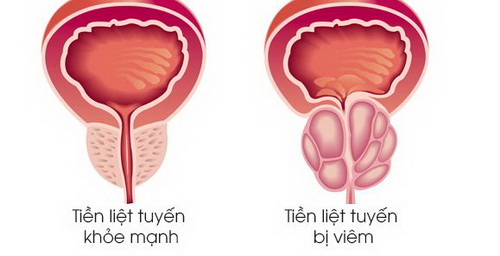 Nam giới bị đau khi yêu, đâu là thủ phạm? Nam giới bị đau khi yêu, đâu là thủ phạm?