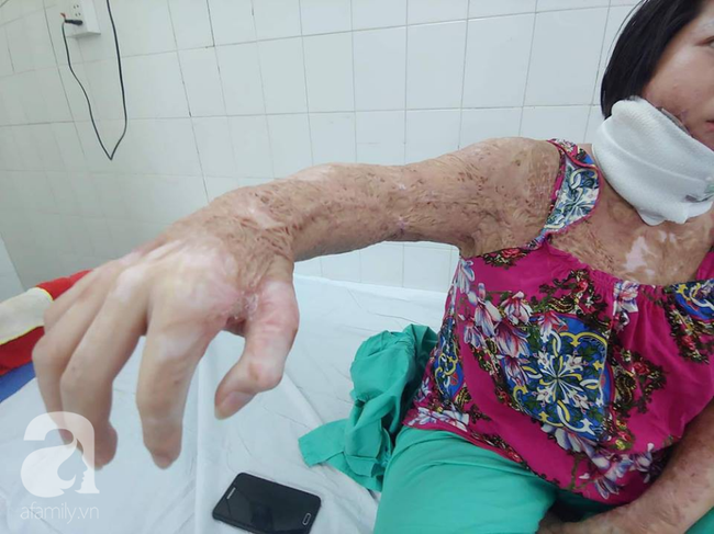 Người vợ bị chồng dùng xăng đốt vì níu kéo tình cảm không thành: 'Tết này em được về với con rồi' - 2 Người vợ bị chồng dùng xăng đốt vì níu kéo tình cảm không thành: 'Tết này em được về với con rồi' - 2