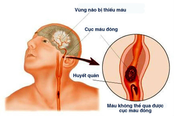 Thức khuya chơi điện tử, nam thanh niên 23 tuổi đột ngột tử vong - 1 Thức khuya chơi điện tử, nam thanh niên 23 tuổi đột ngột tử vong - 1