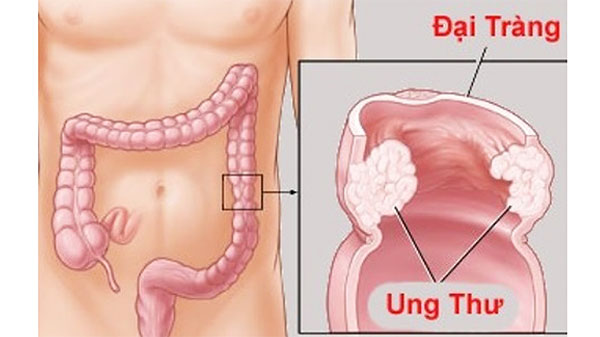 Căn bệnh nghệ sĩ Anh Vũ mắc phải nguy hiểm đến mức nào - 2 Căn bệnh nghệ sĩ Anh Vũ mắc phải nguy hiểm đến mức nào - 2