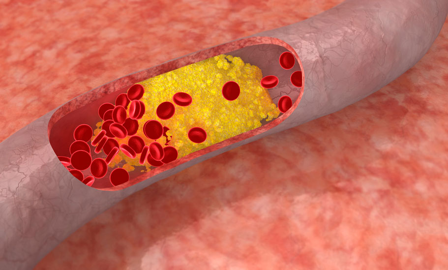 Cholesterol ảnh hưởng đến 'chuyện ấy' thế nào? Cholesterol ảnh hưởng đến 'chuyện ấy' thế nào?