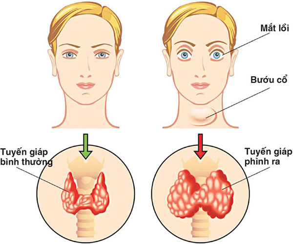 Khi bạn uống nước rồi những vẫn cảm thấy khát: Hãy cảnh giác với 5 căn bệnh nguy hiểm - 2 Khi bạn uống nước rồi những vẫn cảm thấy khát: Hãy cảnh giác với 5 căn bệnh nguy hiểm - 2
